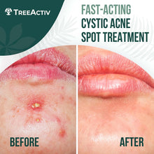 Load image into Gallery viewer, TreeActiv Cystic Acne Spot Treatment, Hormonal Acne Treatment &amp; Overnight Sulfur Cystic Acne Treatment For Face, Pimples, and Blemishes for Adults, Men, and Women - 0.5oz 120+ Uses