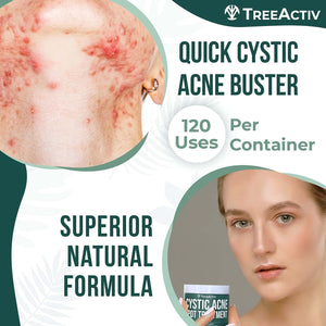 TreeActiv Cystic Acne Spot Treatment, Hormonal Acne Treatment & Overnight Sulfur Cystic Acne Treatment For Face, Pimples, and Blemishes for Adults, Men, and Women - 0.5oz 120+ Uses